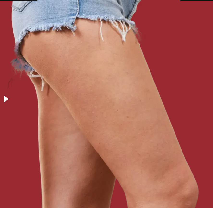 CelluBuster™ | Appareil de massage à ventouses anti-cellulite
